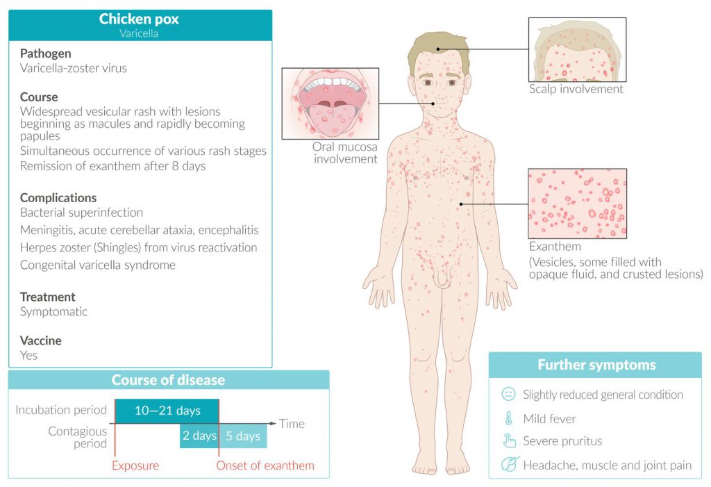 Varicella (Cacar Air) Mudah Menyebar dan Dapat diobati