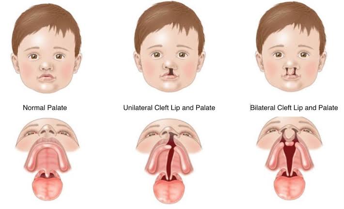 Lindungi Si Kecil dari Bibir Sumbing: Apa yang Perlu Kita Ketahui?